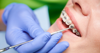 Close-up of a dental professional wearing blue gloves adjusting braces on a patient's teeth with a dental tool.